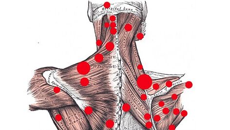 Suaktyvinimo taškai raumenyse, kurie išprovokuoja miofascinį nugaros skausmą