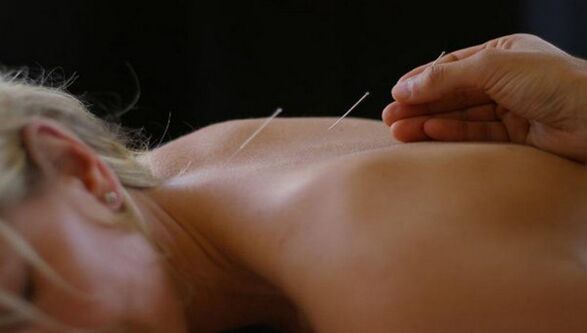 akupunktūra nuo nugaros skausmo