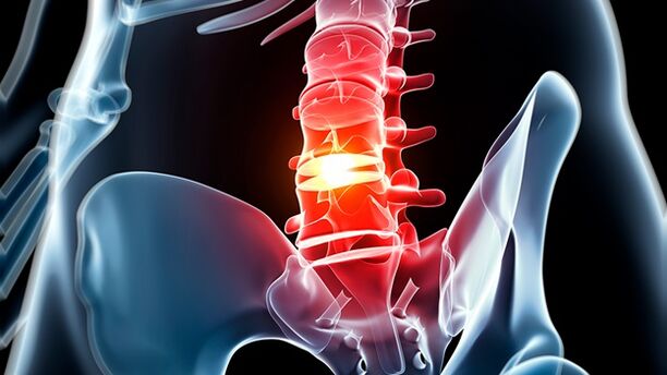 juosmens stuburo osteochondrozė