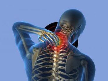 Kaklo stuburo osteochondroze sergantį žmogų vargina kaklo skausmai