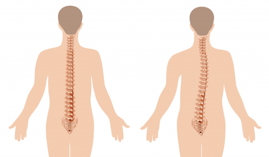 Osteochondrozės pasireiškimas